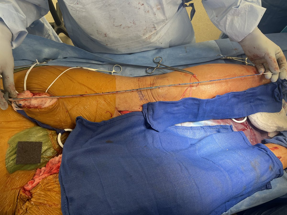 Look at that conduit! Femoral-tibial #bypass with single-segment GSV for #CLTI. An essential skill in #vascsurgery to compliment #endovascular techniques🩸 Image posted with patient permission. #PADed #CLIfighters #limbpreservation