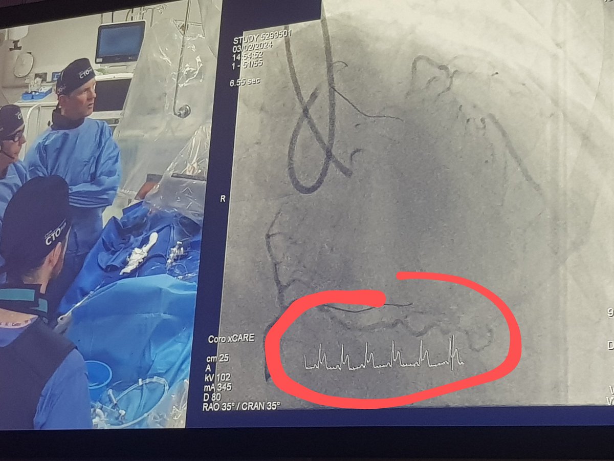ST-Elevation with dual injection in CTO PCI. Good example to keep your eye on the ECG and maybe opt for sequential injections #CTO2024