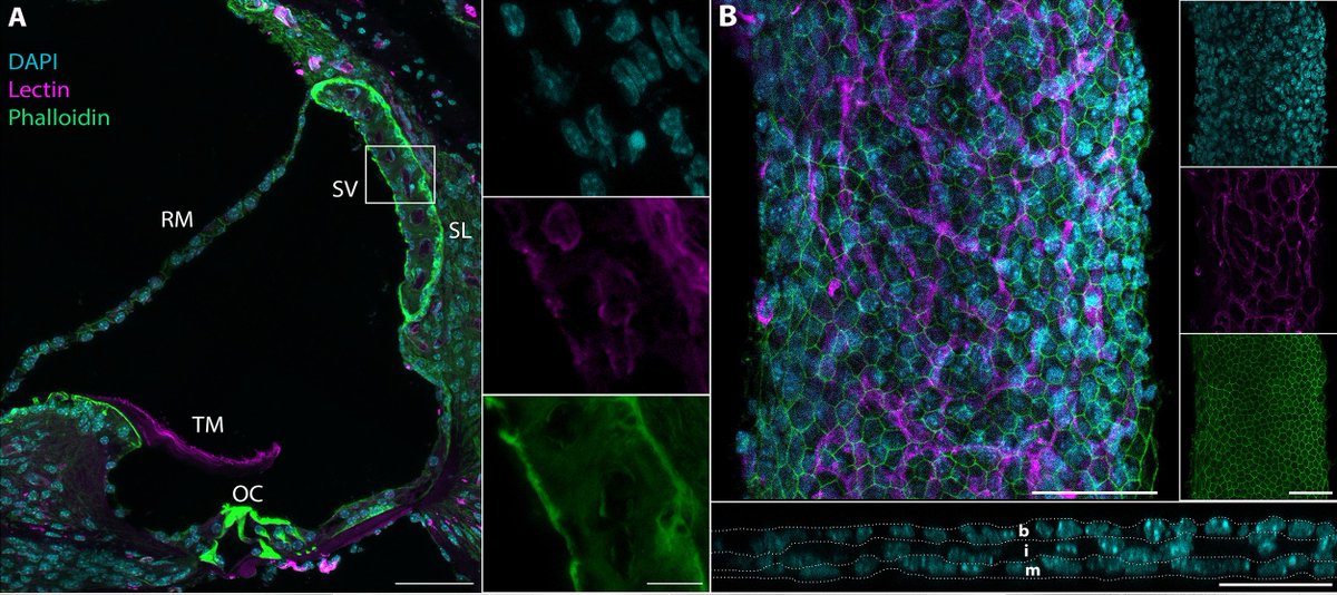 Dabdoub Lab (@labdabdoub) on Twitter photo Today poster S87 <a href="/AROMWM/">ARO</a>. <a href="/matsya_rt/">Matsya</a> <a href="/UofT_LMP/">Department of Laboratory Medicine & Pathobiology</a> will present her latest on culturing the stria vascularis and investigating at single cell level differences between neonatal and adult stria in collaboration with <a href="/MichaelHoaMD/">Michael Hoa, MD</a> @NIDCD
#InnerEar #HearingLoss <a href="/Sunnybrook/">Sunnybrook Health Sciences Centre</a> <a href="/UofT_OHNS/">U of T Otolaryngology - Head & Neck Surgery</a> Today poster S87 <a href="/AROMWM/">ARO</a>. <a href="/matsya_rt/">Matsya</a> <a href="/UofT_LMP/">Department of Laboratory Medicine & Pathobiology</a> will present her latest on culturing the stria vascularis and investigating at single cell level differences between neonatal and adult stria in collaboration with <a href="/MichaelHoaMD/">Michael Hoa, MD</a> @NIDCD
#InnerEar #HearingLoss <a href="/Sunnybrook/">Sunnybrook Health Sciences Centre</a> <a href="/UofT_OHNS/">U of T Otolaryngology - Head & Neck Surgery</a>