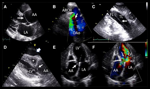 Aortic dissection by TTE.

academic.oup.com/ehjcimaging/ar…

Follow us for more educational posts on EACVI guidelines for Echocardiography. Enhance your knowledge and stay updated with the latest practices. #EACVI #Echocardiography #CardiovascularImaging #KnowYourGuidelines