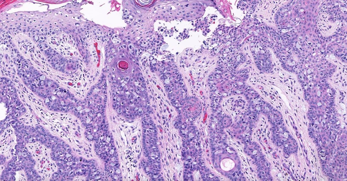 JMGardnerMD's tweet photo. Perianal biopsy. Red plaque.
Digital slide &amp; answer: https://t.co/fxX2QIP420
Differential dx: https://t.co/HONi82iLZL 
Short videos: https://t.co/O56AhvNkMR &amp; https://t.co/1q78BahxWD 
#pathology #pathologists #pathTwitter #dermpath #dermatology #dermtwitter #GIpath #gynpath https://t.co/9wC3w9gjbU