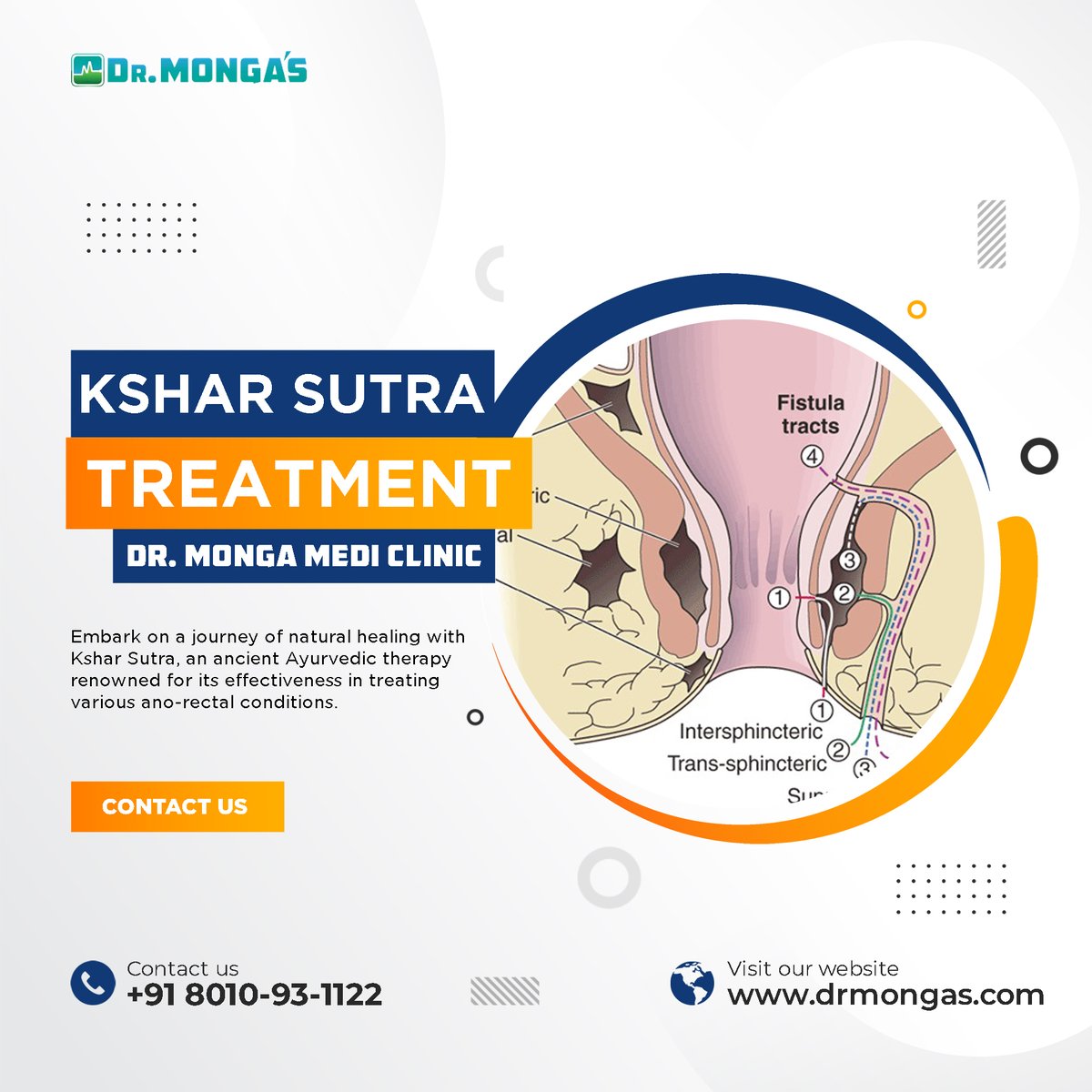 Find the healing power of Kshar Sutra therapy, a minimally invasive Ayurvedic procedure endorsed by Dr. Jyoti Arora. Book your appointment now call +91-8010931122
#piles #constipation #digestion #hemorrhoid #fistulatreatment #ksharsutra #Anorectal #ksharsutra #fissure #fistula