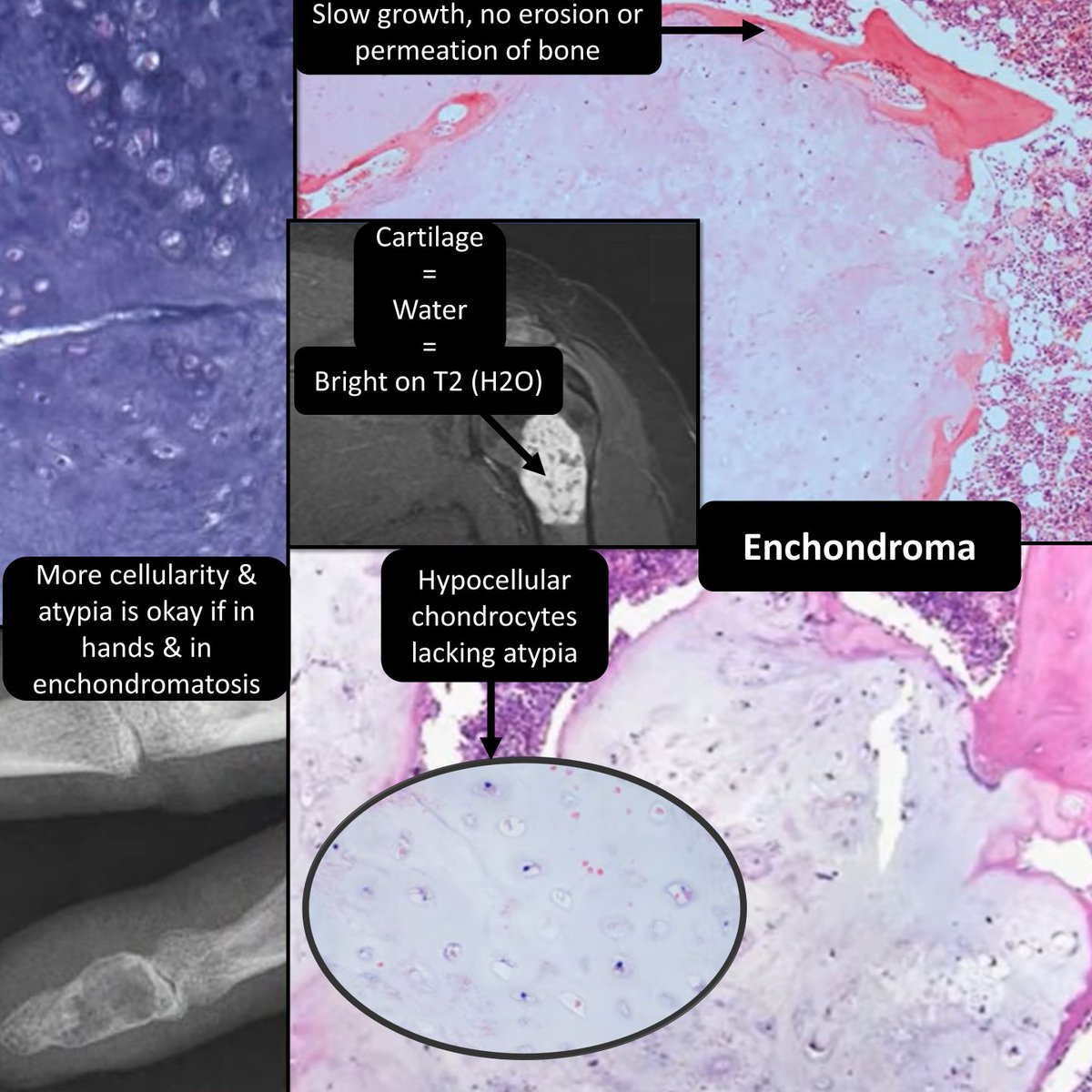 Enchondromatosis tumor syndromes include Ollier Disease & Maffuci Syndrome. Both show ↑ incidence of chondrosarcomas & gliomas. Maffuci syndrome will also present with multiple spindle cell &/or cavernous hemangiomas.
#PediPath #BSTPath #PathTwitter #PathResidents #MolPath…