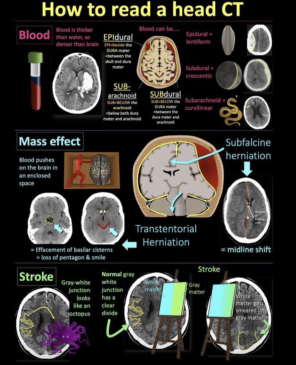 Basics of Head CT @teachplaygrub