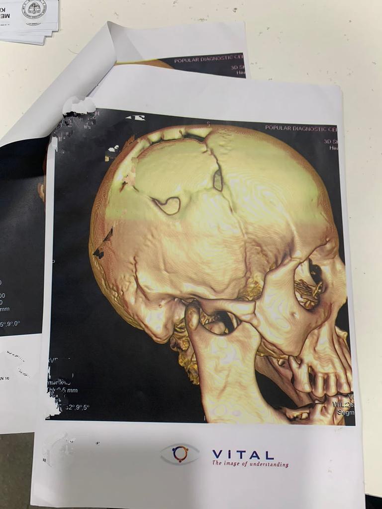 _weedhamza's tweet photo. OPDs were mostly about learning radiology, physical examinations and common neurological presentations. https://t.co/ixGDf34Coe