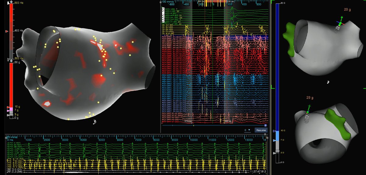 Dilated atria, a Left Common, prior (durable) PVI. Incorporating Omnipolar Technology, Peak Frequency, & Near Field algorithms, #TactiFlex resulted in #AFib termination. @CirculationEP 

Revisting EGM characterization 
ahajournals.org/doi/10.1161/CI…

@JeffHsingMD @jordinarymaps #PMA