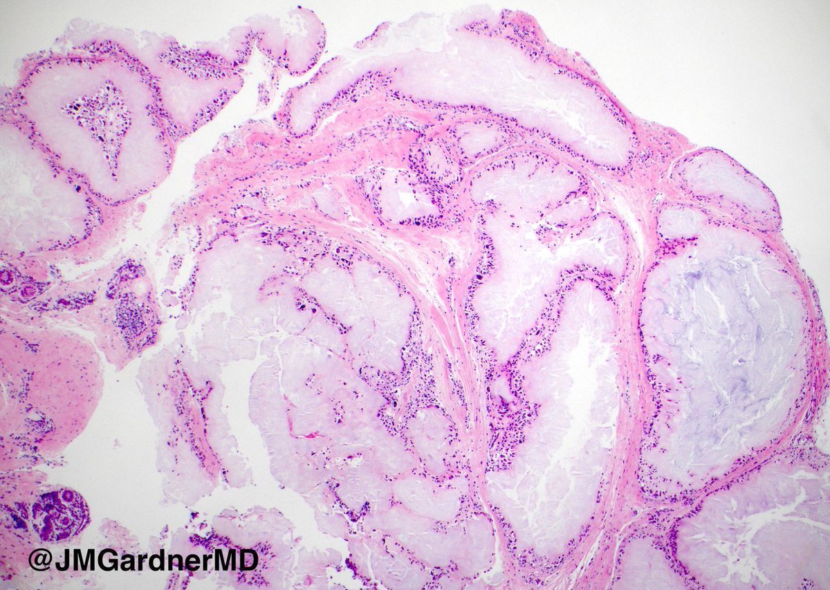 A #pathology classic! Can you make the diagnosis on this one H&amp;E pic? Click here for answer with video: kikoxp.com/posts/3799 #Pathology #dermpath #dermatology #dermatologia #dermtwitter #BSTpath