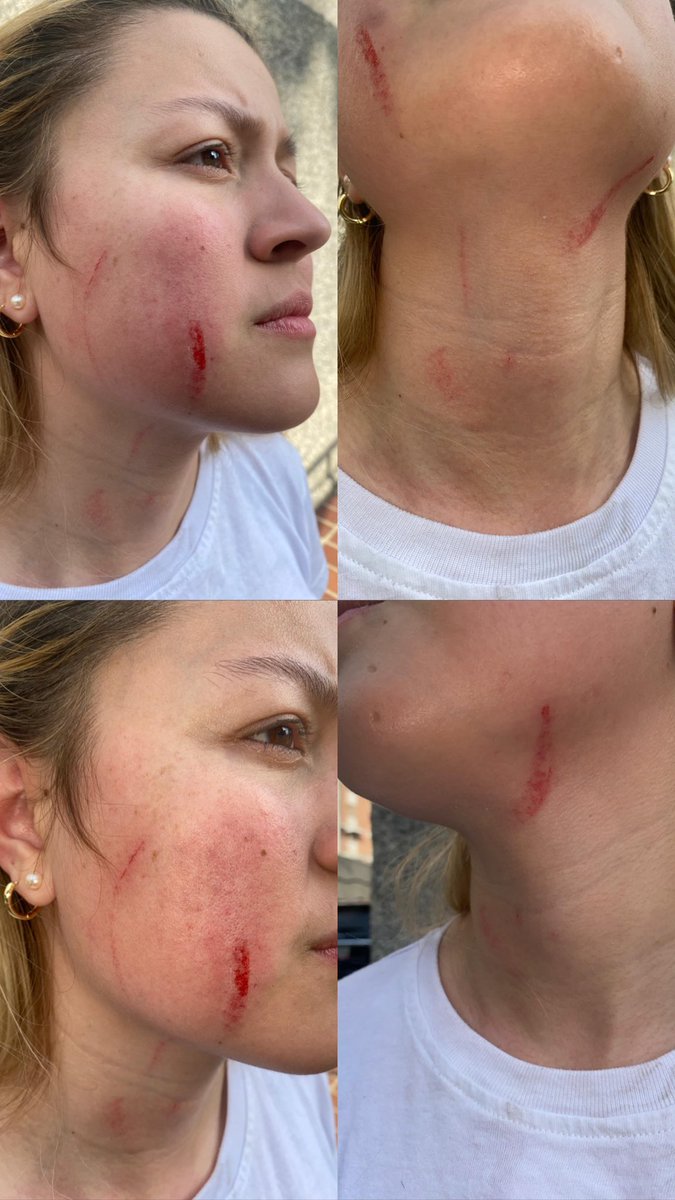 anyelithetc's tweet photo. #DENUNCIA #AHORA Fui golpeada y agredida por representantes del @PartidoPSUV El Valle. La ruta nunca será la violencia, queremos un cambio en PAZ. Quienes practicamos la democracia no toleraremos estos actos!!! El diálogo no se construye con golpes!!! https://t.co/Opf8oFhyOv