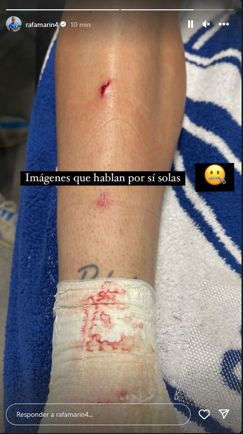 Le tritura la tibia, amarilla clamorosa, retiro lo dicho, no se equivoca el árbitro.