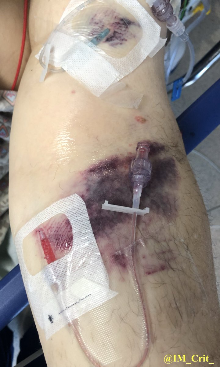 IM_Crit_'s tweet photo. ICU stories:
A picture is worth 1,000 words, so 2 pictures... Do the math!

50yo, massive GI bleed, already 3 u of blood for hemorrhagic shock, on the vent, on pressors/sedation etc
Me: Is he "lined"?
Colleague: No, but is OK, has plenty of access, has 3 peripheral ivs
Patient:👇 https://t.co/Zuenko1yOi