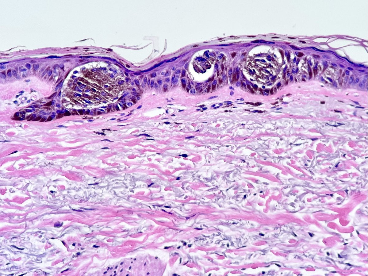 The 'Eyeliner Sign' in melanoma! While the #EyelinerSign is often linked with SCC in situ/Bowen’s disease or occasionally Paget’s, this case of nevoid (nested) melanoma in situ is showcasing the same distinctive feature. #DermPath #PathTwitter #pathfulness