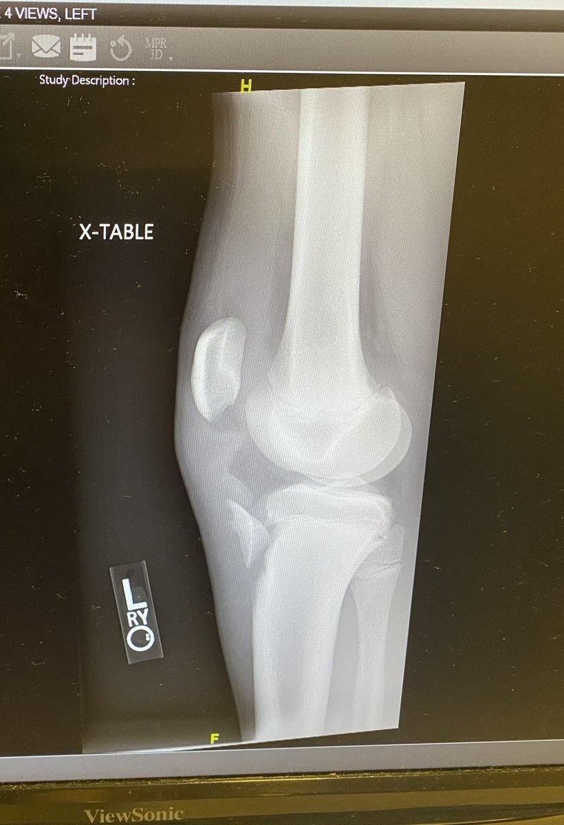 Grant Lanier (@grant_lanier5) on Twitter photo In June 2022 I suffered a torn patella tendon along with fracturing my tibia. After a long, painful, rehabilitation journey, as of January 2024 Iโm thrilled to announce that I have been cleared to continue doing what I love <a href="/HMAVBB/">Hargrave Men's VBB</a>. GRIND WONโT STOP! In June 2022 I suffered a torn patella tendon along with fracturing my tibia. After a long, painful, rehabilitation journey, as of January 2024 Iโm thrilled to announce that I have been cleared to continue doing what I love <a href="/HMAVBB/">Hargrave Men's VBB</a>. GRIND WONโT STOP!