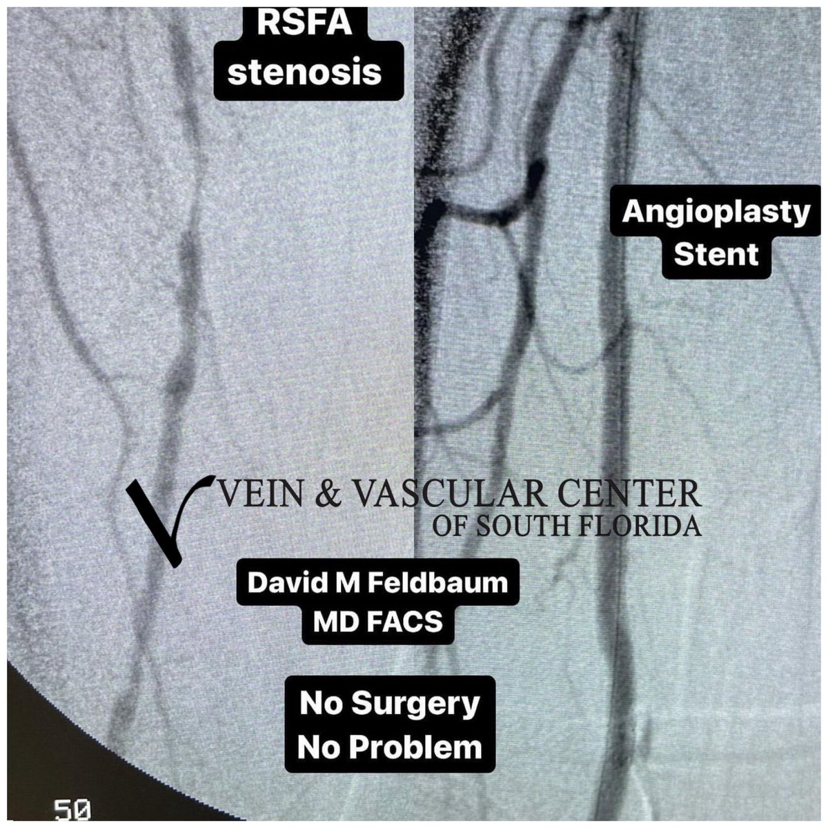 GotVeins's tweet photo. We Accept Most Insurance. Call 954-964-6684 To Schedule Your Appointment. 

#Angioplasty #vascularsurgeon #vascularsurgery https://t.co/y8J2AFvLtS