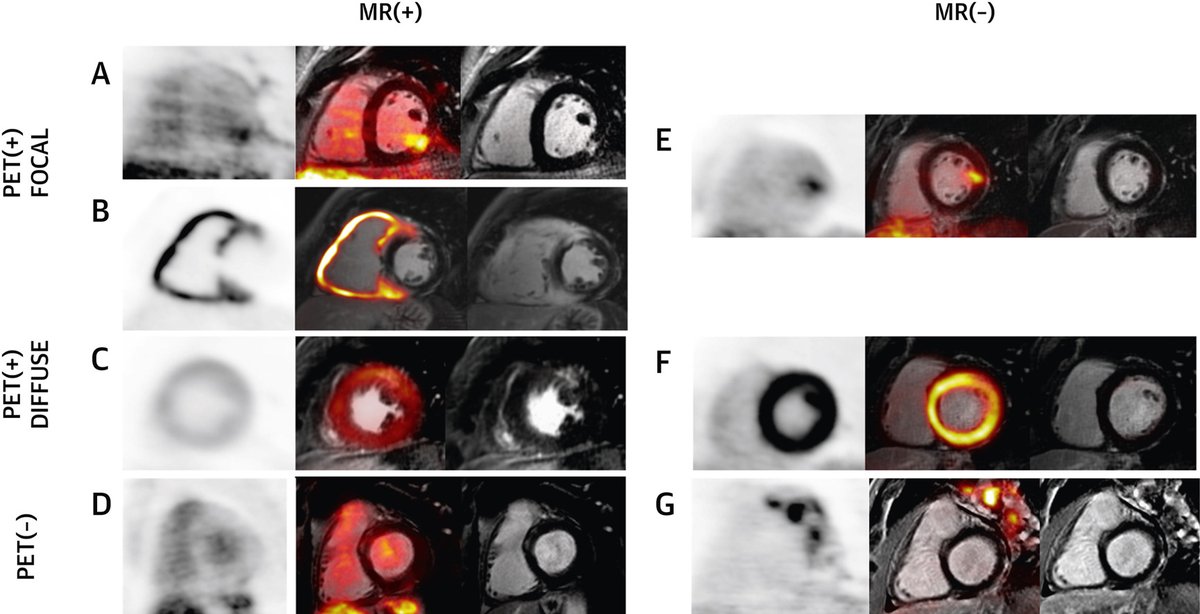 Congrats <a href="/mgtrivieri/">Maria G. Trivieri</a> + coauthors for showing hybrid PET-MRI has utility to guide  prognostication &amp; treatment in cardiac sarcoid. 
jacc.org/doi/10.1016/j.…

<a href="/zahifayad/">zahifayad</a> <a href="/BMEIIsinai/">BioMedical Engineering and Imaging Institute</a> <a href="/MountSinaiHeart/">Mount Sinai Fuster Heart Hospital</a>  <a href="/doctorginaL/">Dr. Gina LaRocca❤️</a> <a href="/MountSinaiChest/">@MountSinaiChestRadiology</a>  <a href="/PanChristia/">Panagiota Christia</a> <a href="/SinaiHeartBlood/">Cardiovascular Research Institute at Sinai (CVRI)</a> <a href="/VictorChangInst/">Victor Chang Cardiac Research Institute</a>