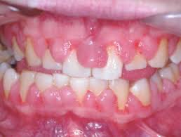 drsamshuaibi's tweet photo. Gingival Hyperplasia is seen with which medication usage?🤔🤔

#Usmle #DrSam👩🏼‍⚕️🩺 #medtwitter #match2024 #match2023 #ecfmg #ecfmgcertificate https://t.co/J9kzo6q3Dw