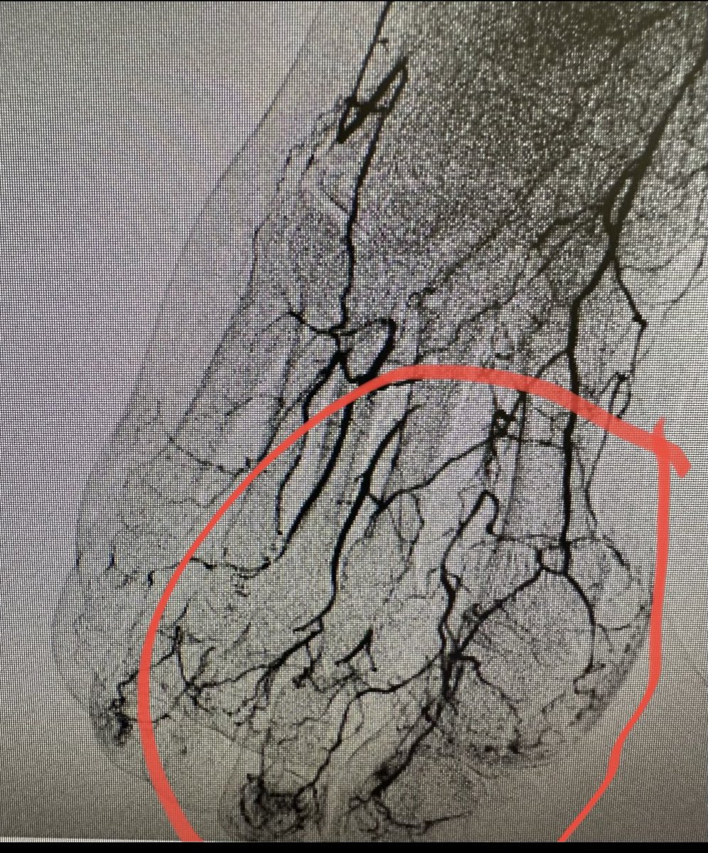 Any options for this patient? Here is the fix, let’s see if pt heals! @SIRspecialists @ACCinTouch @VascularSVS @CLI_Global @_MCLIN_ @CLIjournal @kmadass @Watts_IR @LessneVIR @SDhandMD @roblookstein @bretwiechmann @MisraMD @paragpatel_IR