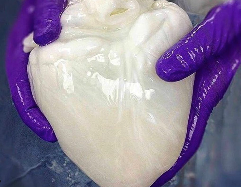 Rainmaker1973's tweet photo. This image shows a decellularized heart, stripped of all native cells, leaving behind an intact vascular system and a scaffold that has been infused with stem cells. 

One of the greatest limitations to organ transplantation derives from organ rejection caused by antibodies of the transplant recipient reacting to donor antigens on cell surfaces within the donor organ.

By recellularizing an decellularized organ with a patient’s own cells, the adverse immune response is eliminated.
⁠
[📸 mdhealthtips ]