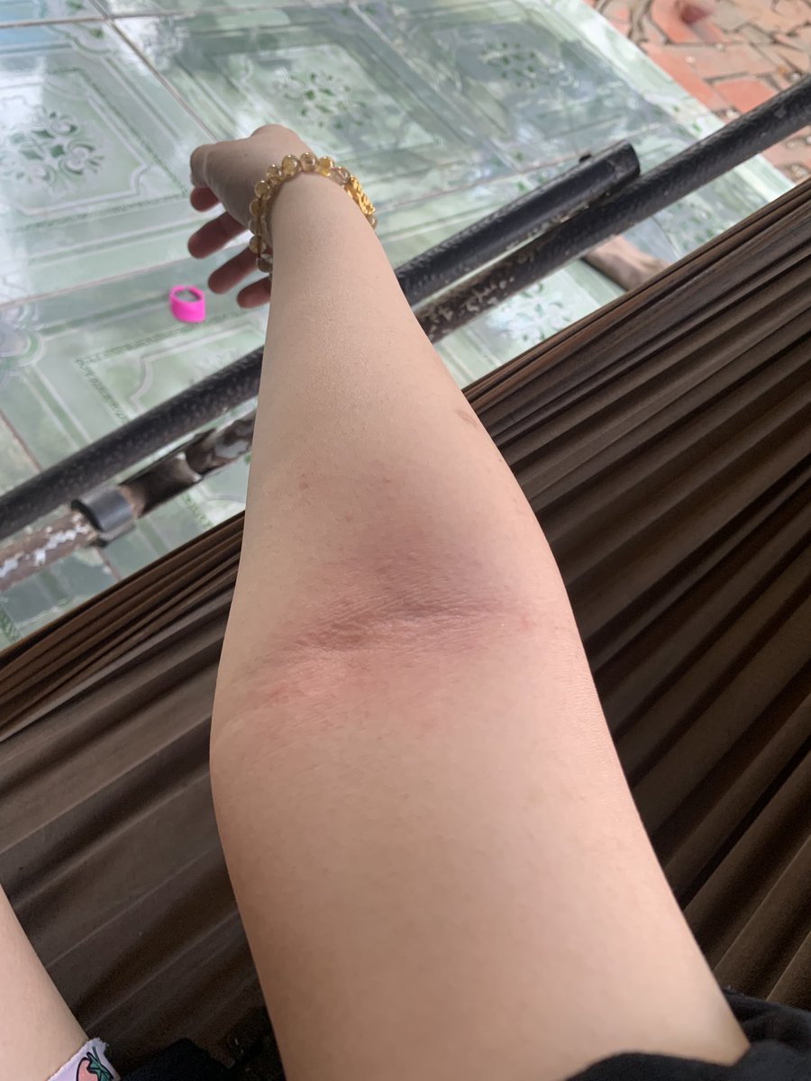 TAT19992's tweet photo. Đội nón ra vườn hái sơ ri rồi bị sâu lông 🐛 rơi vào tay 😂 ngứa sưng cả tay https://t.co/OYtGVYoDoF