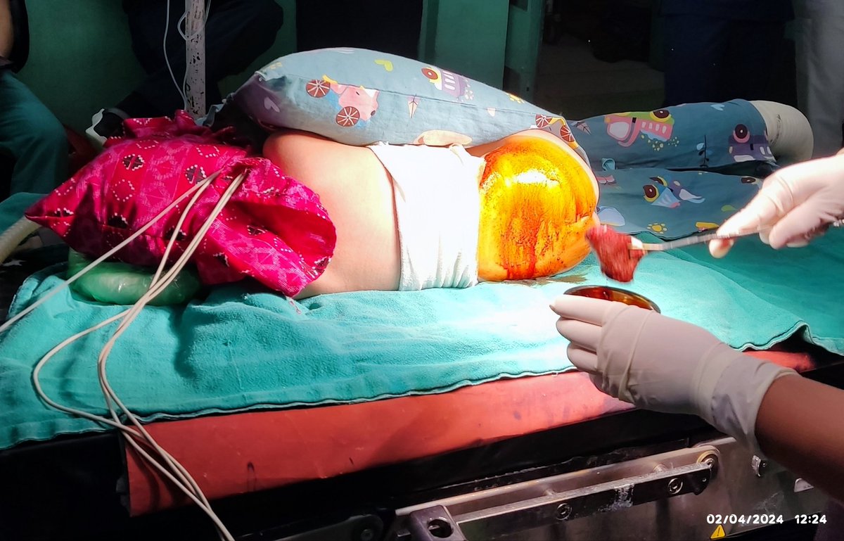 DrUtsavAcharya1's tweet photo. Untreated/undertreated pain in infancy leads to behavioral maladaptation in kids as they grow up
Delivering intrathecal morphine as a part of MMA regimen in an infant undergoing transabdominal pull through surgery @GICSurgery
#pedanesthesia #TUTHanesthesia #SurgicalCare4Kids https://t.co/DoUVagwTK1