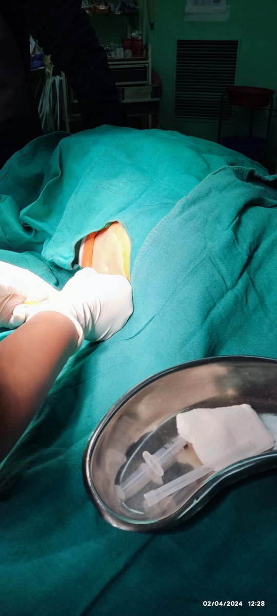 DrUtsavAcharya1's tweet photo. Untreated/undertreated pain in infancy leads to behavioral maladaptation in kids as they grow up
Delivering intrathecal morphine as a part of MMA regimen in an infant undergoing transabdominal pull through surgery @GICSurgery
#pedanesthesia #TUTHanesthesia #SurgicalCare4Kids https://t.co/DoUVagwTK1
