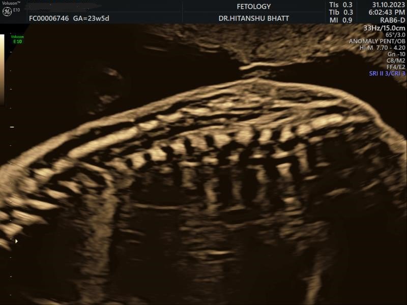 SocietyofFetMed's tweet photo. Question 115: What is your diagnosis?

Case credit: Dr. Hitanshu Bhatt &amp; Dr. Gouri Nagraj

Follow for more

#maternalmedicine #fetal #fetalmedicine #societyoffetalmedicine #fmf #fetomaternalmedicine #sfm
#isuog #diagnosis #medtwitter #fetalmed https://t.co/Qvv8Dv5SNq