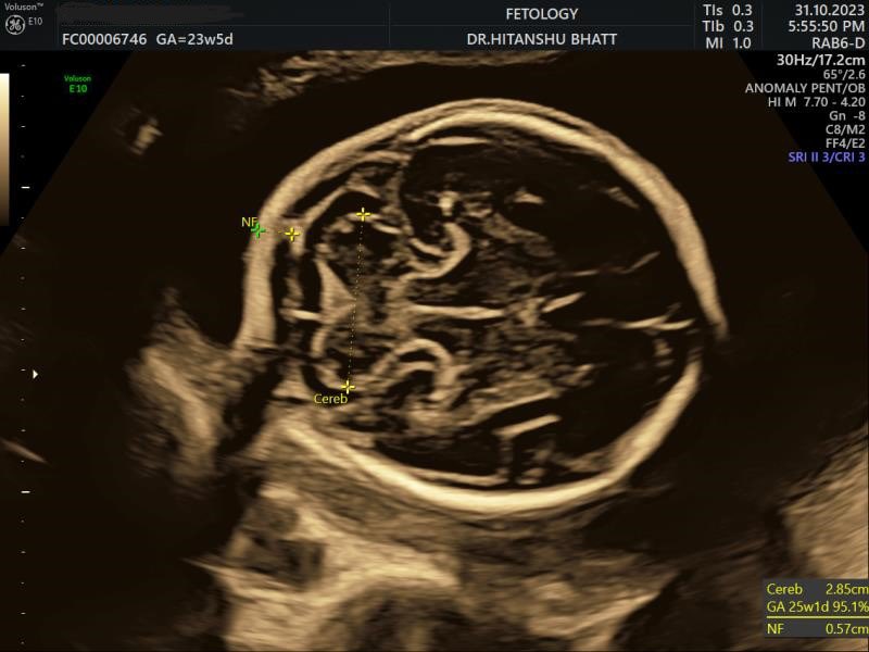 SocietyofFetMed's tweet photo. Question 115: What is your diagnosis?

Case credit: Dr. Hitanshu Bhatt &amp; Dr. Gouri Nagraj

Follow for more

#maternalmedicine #fetal #fetalmedicine #societyoffetalmedicine #fmf #fetomaternalmedicine #sfm
#isuog #diagnosis #medtwitter #fetalmed https://t.co/Qvv8Dv5SNq