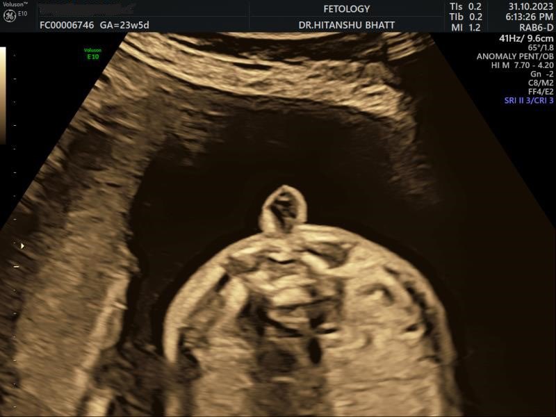 SocietyofFetMed's tweet photo. Question 115: What is your diagnosis?

Case credit: Dr. Hitanshu Bhatt &amp; Dr. Gouri Nagraj

Follow for more

#maternalmedicine #fetal #fetalmedicine #societyoffetalmedicine #fmf #fetomaternalmedicine #sfm
#isuog #diagnosis #medtwitter #fetalmed https://t.co/Qvv8Dv5SNq