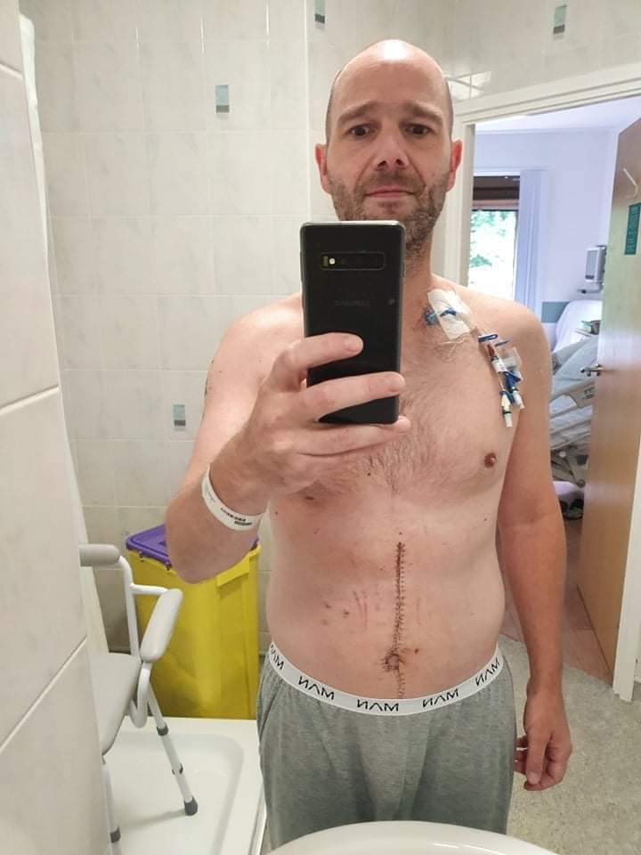 crookie1871's tweet image. 2 years ago i had just finished FOLFOX chemo following MOAS crs hipec 11 hour surgery and losing five organs! N
Been NED since and next scan July 🤞 
I have a rare form of appendix cancer called goblet cell anadenocarcinoma 
 #WorldCancerDay #appendixcancer #moas #hipec #folfox