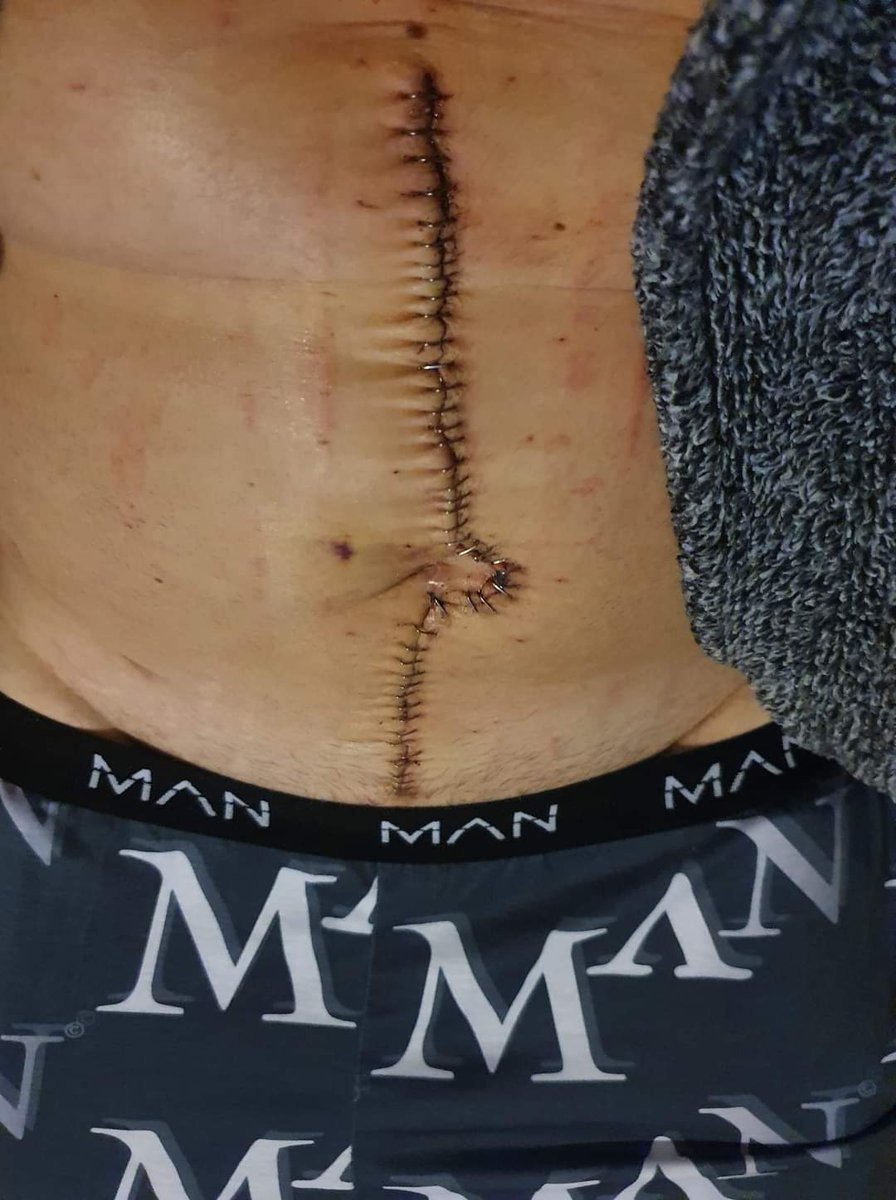 crookie1871's tweet image. 2 years ago i had just finished FOLFOX chemo following MOAS crs hipec 11 hour surgery and losing five organs! N
Been NED since and next scan July 🤞 
I have a rare form of appendix cancer called goblet cell anadenocarcinoma 
 #WorldCancerDay #appendixcancer #moas #hipec #folfox