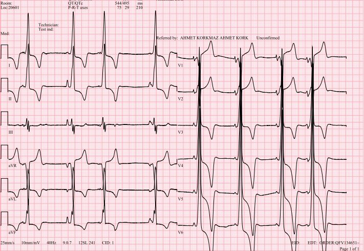 Yuksek Ihtisas Arrhythmia- Ankara City Hospital (@ach_epteam) on Twitter photo PAC with fixed preexcitation in coexistence of familial pseudo-HCM and pseudo-WPW❓ <a href="/AhmetKorkmaz07A/">Ahmet</a> <a href="/ElifhandeMD/">Elif Hande Özcan Çetin</a> <a href="/Mkara_EP/">Mkara</a> <a href="/drfiratozcan/">Fırat Özcan</a> <a href="/prof_serkan_cay/">Prof Dr Serkan Cay</a> <a href="/ozcanozeke/">Özcan Özeke</a> <a href="/KennethEllenbo1/">Kenneth Ellenbogen</a> <a href="/EduardoSternick/">eduardo sternick</a> <a href="/DursunAras2/">Dursun Aras, Professor</a> <a href="/topaloglu_prof/">Serkan Topaloglu, MD</a>
doi.org/10.1161/CIRCEP…
doi.org/10.1161/CIRCEP… PAC with fixed preexcitation in coexistence of familial pseudo-HCM and pseudo-WPW❓ <a href="/AhmetKorkmaz07A/">Ahmet</a> <a href="/ElifhandeMD/">Elif Hande Özcan Çetin</a> <a href="/Mkara_EP/">Mkara</a> <a href="/drfiratozcan/">Fırat Özcan</a> <a href="/prof_serkan_cay/">Prof Dr Serkan Cay</a> <a href="/ozcanozeke/">Özcan Özeke</a> <a href="/KennethEllenbo1/">Kenneth Ellenbogen</a> <a href="/EduardoSternick/">eduardo sternick</a> <a href="/DursunAras2/">Dursun Aras, Professor</a> <a href="/topaloglu_prof/">Serkan Topaloglu, MD</a>
doi.org/10.1161/CIRCEP…
doi.org/10.1161/CIRCEP…