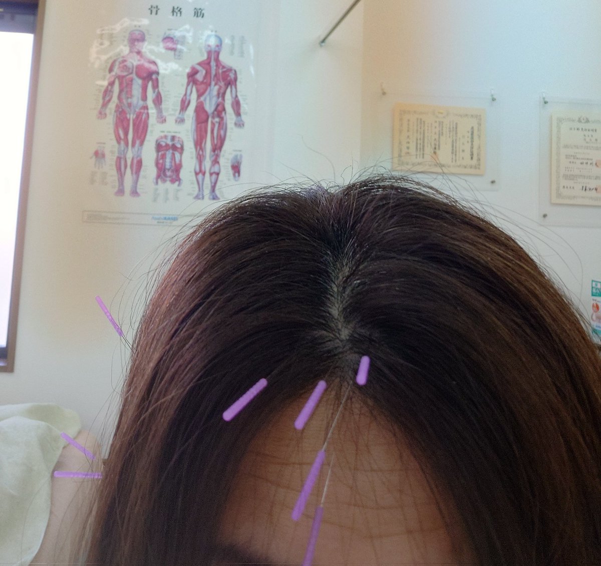 rinko_rin_rin's tweet photo. 足が痛いと言ったらデコにトリケラトプスの角のように針を刺された https://t.co/tjT1xRXzmG