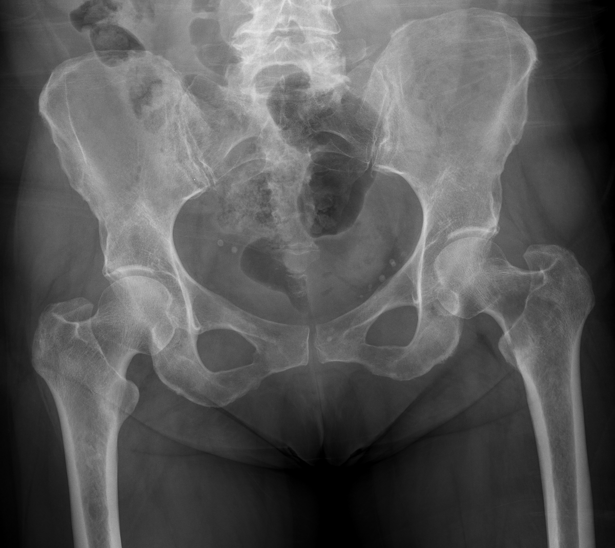What is the main abnormality on this pelvic radiograph of a middle aged female? 🧐

#radiology #spotter #FRCR