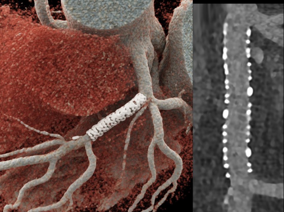 Dr Shariq Shamim (@shariqshamimmd) on Twitter photo Current state of the art CCTA is next level. I wish these machines and post-processing software were more accessible and not cost-prohibitive. At this resolution level, CCTA appears to be better than an invasive coronary angiogram.
Originally shared by <a href="/FCademartiri/">Dr. Filippo Cademartiri</a> Current state of the art CCTA is next level. I wish these machines and post-processing software were more accessible and not cost-prohibitive. At this resolution level, CCTA appears to be better than an invasive coronary angiogram.
Originally shared by <a href="/FCademartiri/">Dr. Filippo Cademartiri</a>