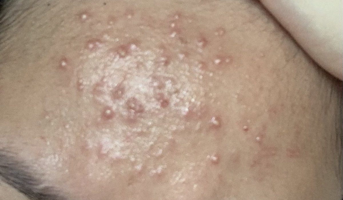 k1naas's tweet photo. TW‼️Update: 

I jumpa Dr sebab dah melarat &amp; taknak palatao. So Dr bagitahu my skin inflamed. Dapat ubat antibiotic, anti-allergy &amp; cream. 

Kena elak or kurangkan makan dairy, spicy foods (🥹), sugar, fast foods, seafood, goreng goreng for now~ https://t.co/yr1k4HCai9