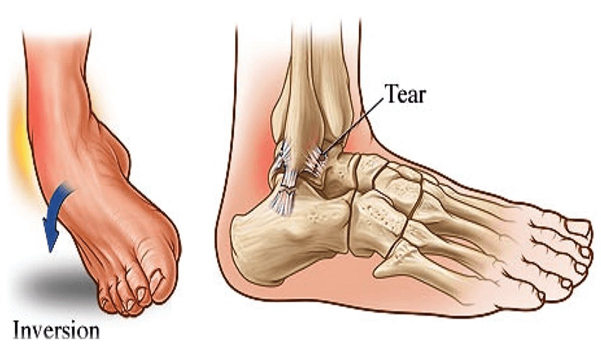 Inverted Ankle sprain mechanism