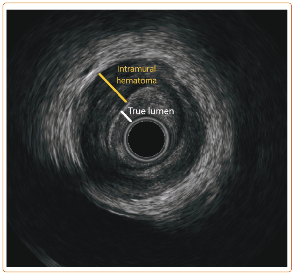 📜@CardioNerds #USCardiology Article Alert‼️ Our 1⃣st Clinical Image: 💔'Tearin’ Up My Heart: Intramural Hematoma in SCAD' by @iconsideritjoy & @SKrishMD007 🔗uscjournal.com/articles/teari…