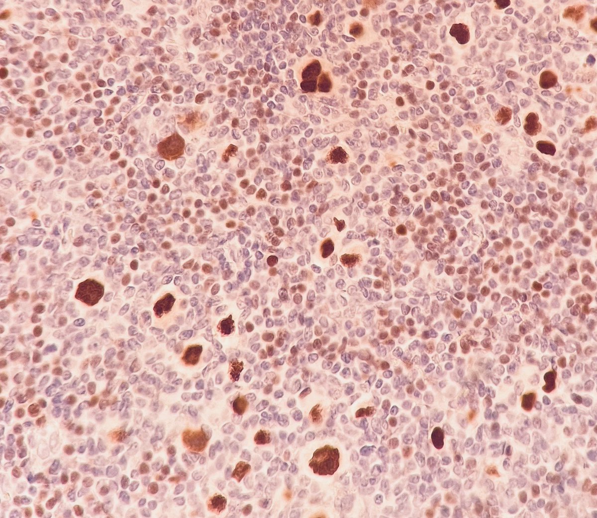 What is the cell and what is the stain? #hemepath #IHCpath #pathology