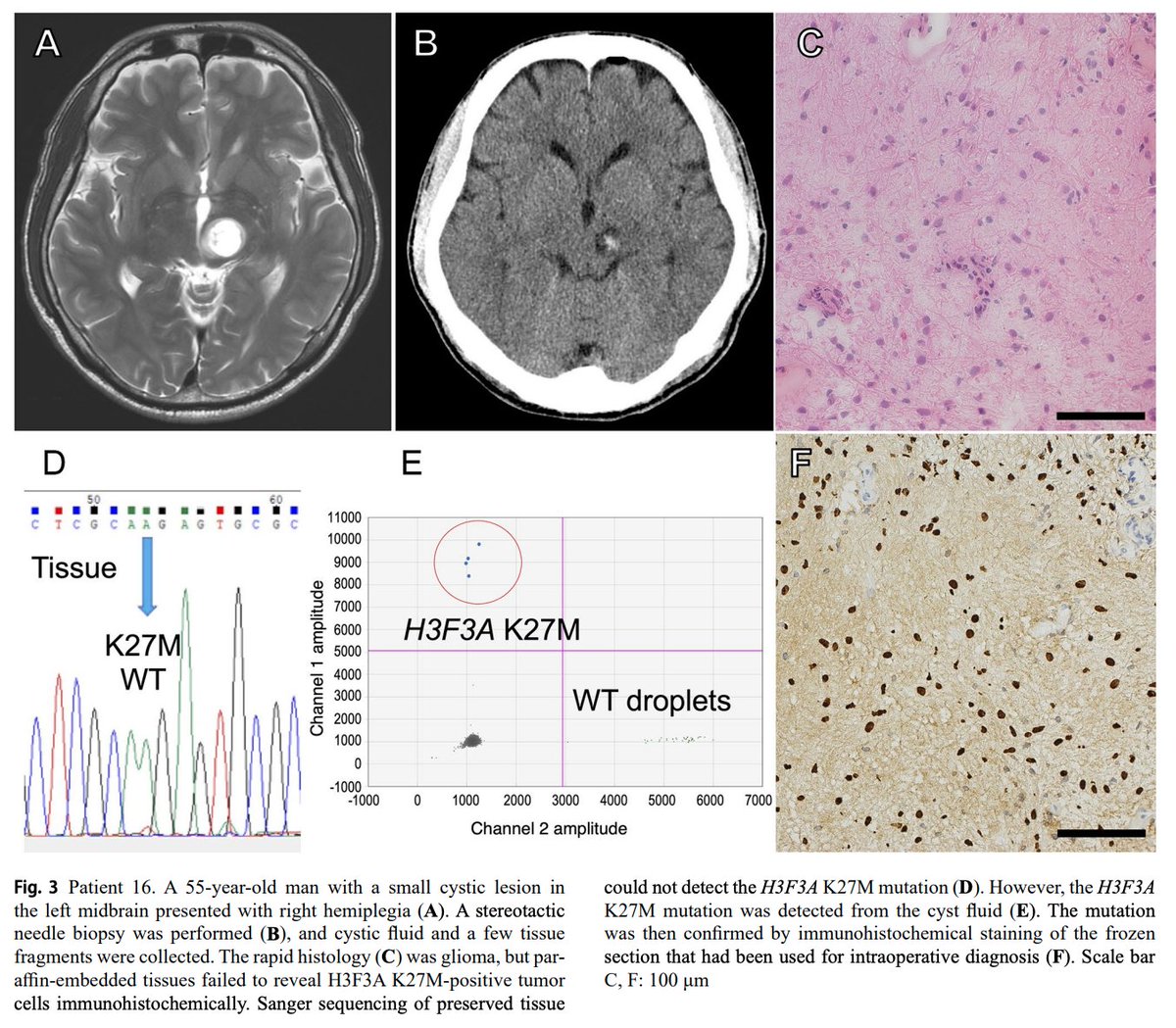 JNeurooncol's tweet image. On et al. from @Niigata_Univ_O show that diagnostic mutations can be reliably detected from #cellfreeDNA in the cystic fluid of glial tumors, which may be an alternative sampling source to tumor tissue 
link.springer.com/article/10.100…