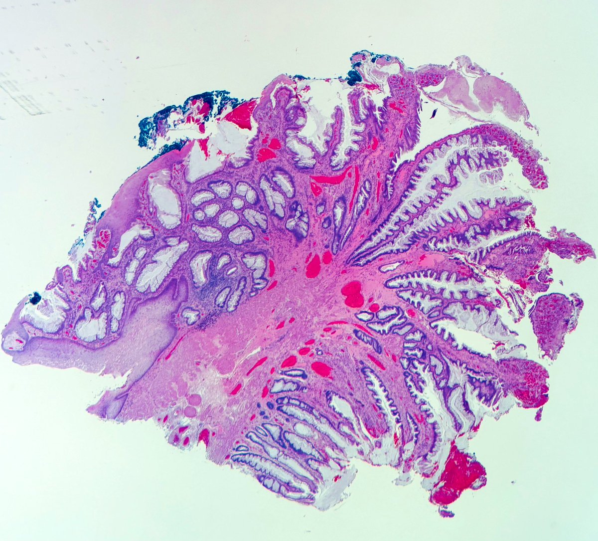 Anal canal 
Inflammatory cloacogenic polyp 
#everydayGI #PathX #pathtwitter #pathology #surgpath #pathresidents #pathologists