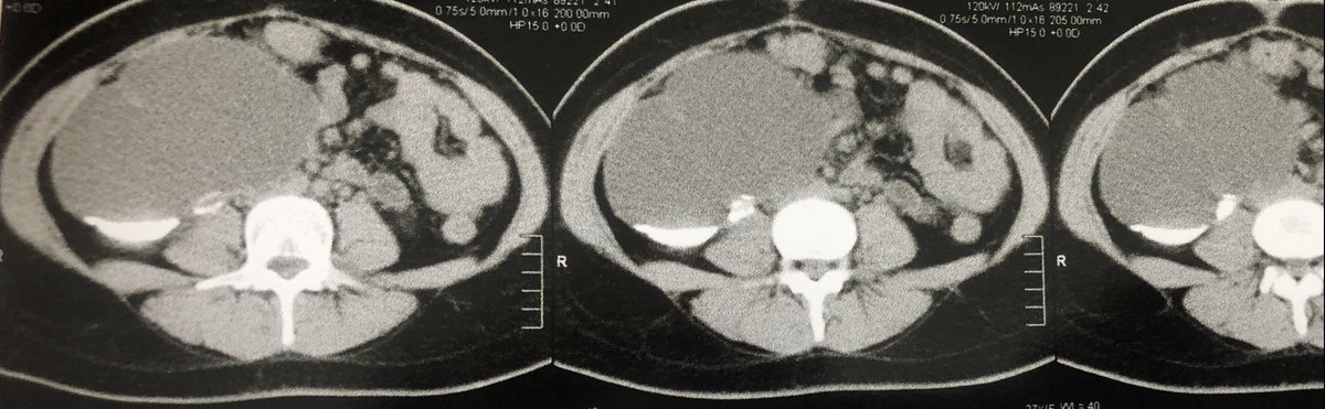 Milk of calcium stones. You should suspect if stone is radiolucent in KUB and shows fluid level in dilated calyx.
My article in Urolithiasis 

link.springer.com/article/10.100…