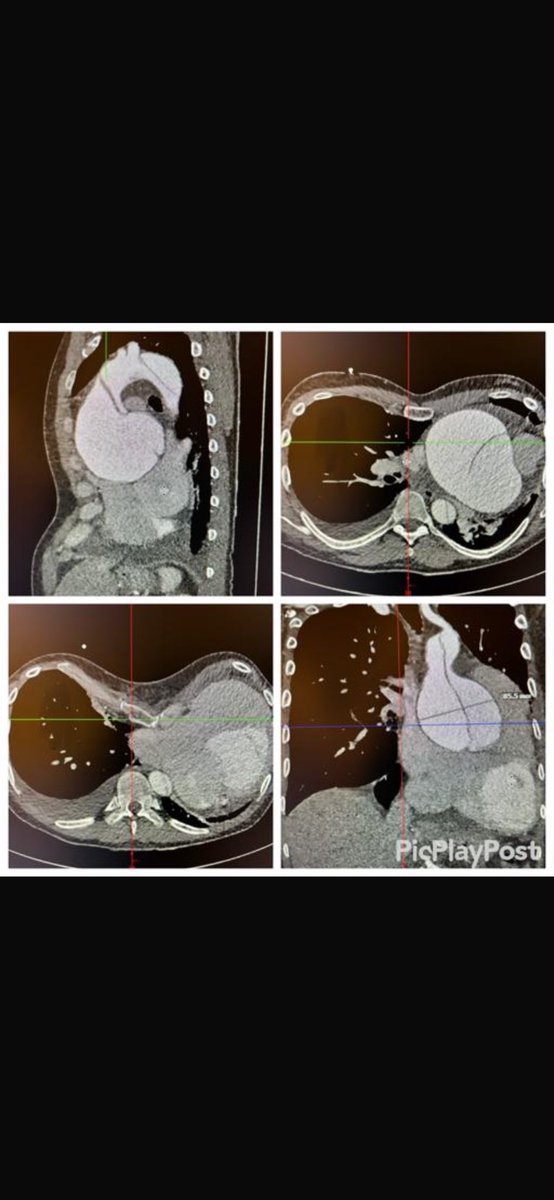 Challenge of the Week…

Pectus Excavatum, Huge Aortic Aneurysm 85mm with Aortic Dissection, Aortic valve regurgitation, 51 y male, Ejection Fraction 20%

Challenge: Chest Entry 

Extrathoracal CBP, On-X Bentall 25mm, Hemiarch