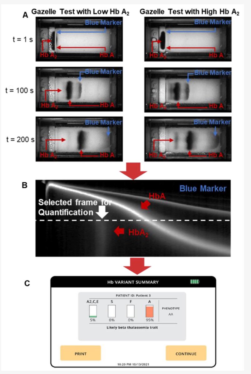 Happy to share this collaborative publication on a much needed new affordable point-of-care test for #betathalassemia: 

Point-of-Care Diagnostic Test for Beta-Thalassemia mdpi.com/2664646 #mdpibiosensors via @Biosensors_MDPI
👇
mdpi.com/2079-6374/14/2…