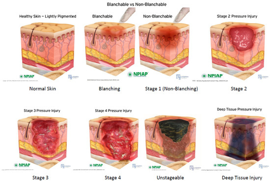 JPM_MDPI's tweet photo. 📢Check out today's #Highly_Cited Paper
📕"Pressure Injuries and Management after Spinal Cord Injury"

👨‍🔬Nicole M. Vecin et al.
🏫University of Miami Miller School of Medicine
👍 Article Views 11039; Citations 10
🎯 https://t.co/IyZ4P2OtRw
@MDPIOpenAccess @MediPharma_MDPI https://t.co/ViiNLxMmIE