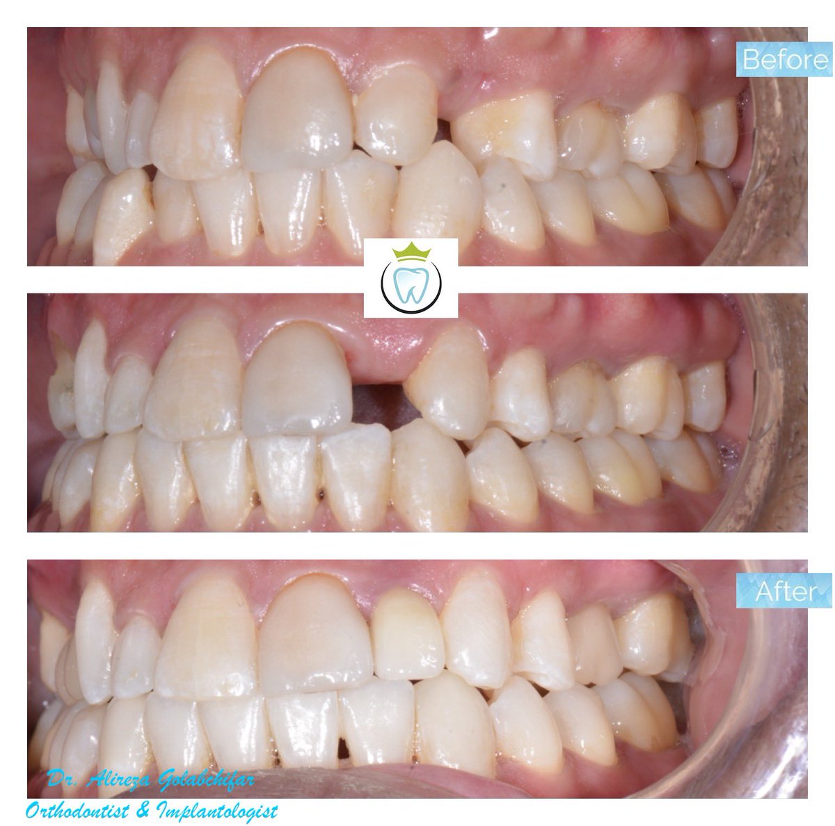 dentistry_king's tweet photo. Check out this Transformation!
This patient came to us with congenital missing of teeth 14, 15, 22, 25 and crowding in lower teeth. With the help of a combination of orthodontic treatment, implant placement, and a sinus lift on the right side, we could give him a beautiful smile. https://t.co/1plGNeZhTR