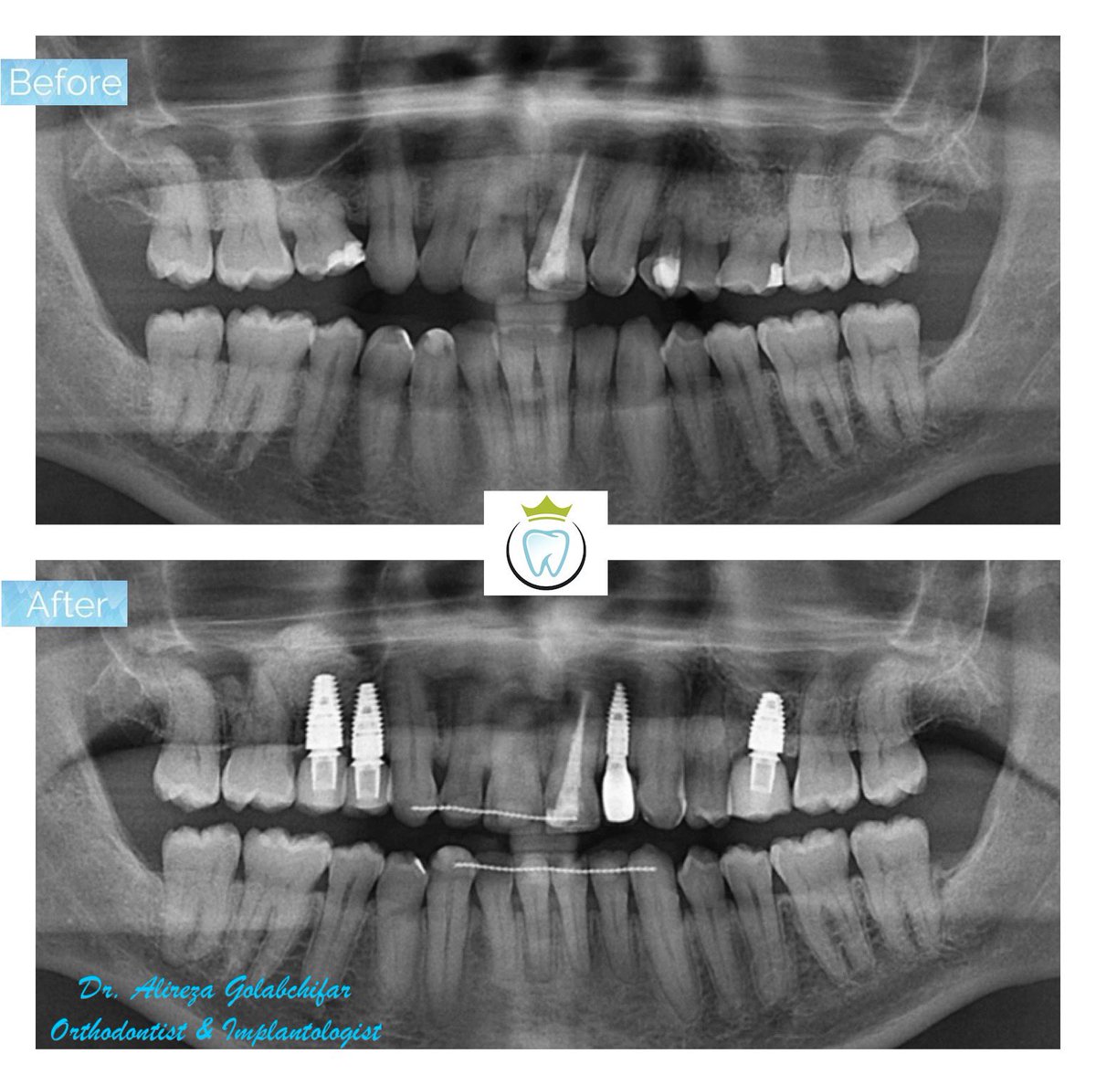 dentistry_king's tweet photo. Check out this Transformation!
This patient came to us with congenital missing of teeth 14, 15, 22, 25 and crowding in lower teeth. With the help of a combination of orthodontic treatment, implant placement, and a sinus lift on the right side, we could give him a beautiful smile. https://t.co/1plGNeZhTR