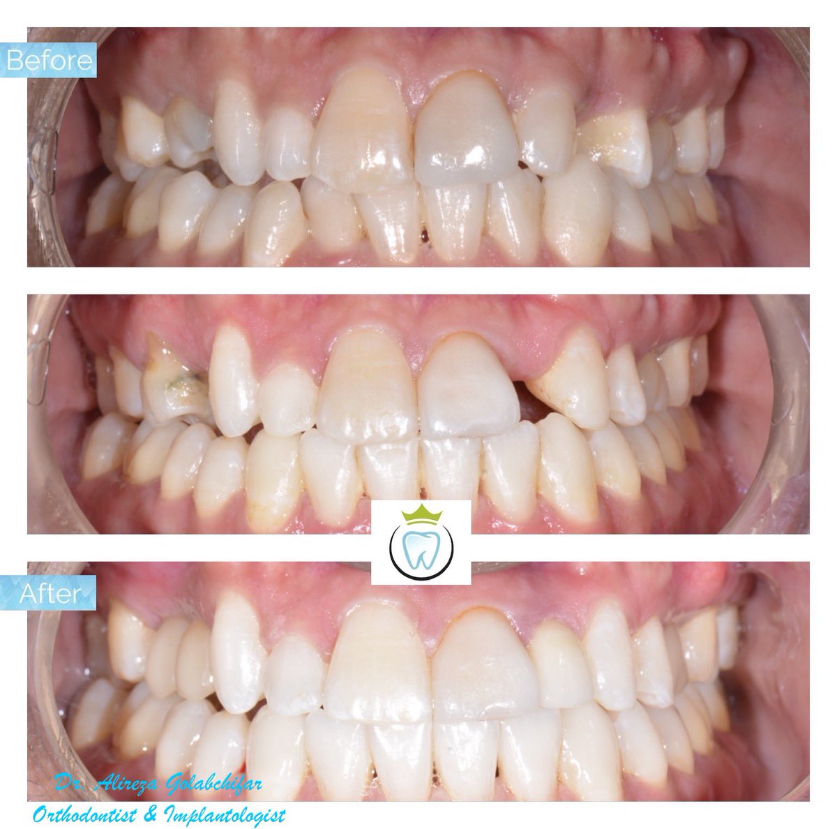 dentistry_king's tweet photo. Check out this Transformation!
This patient came to us with congenital missing of teeth 14, 15, 22, 25 and crowding in lower teeth. With the help of a combination of orthodontic treatment, implant placement, and a sinus lift on the right side, we could give him a beautiful smile. https://t.co/1plGNeZhTR