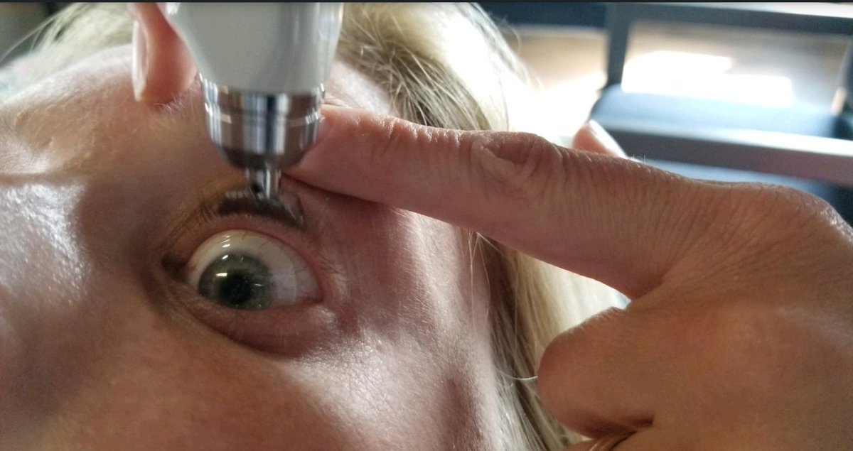 TONOMETRY's tweet photo. 👁 Diaton #Tonometer & Its Benefits with #Scleral Lenses
https://t.co/DNZiKdAKh6
The study by Michaud et al. highlights the importance of monitoring #IOP in patients using #sclerallenses and underscores the potential benefits of employing #Diaton Tonometer
#Optometry #glaucoma https://t.co/BdINNtlZHs