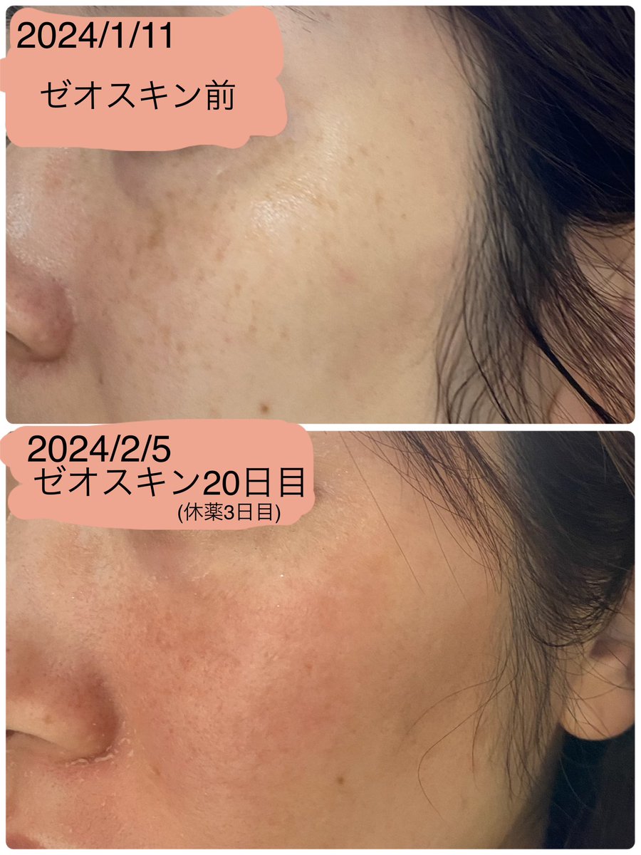 ゼオスキンセラピューティックの経過 1週間目…4日目から皮むけ開始。後半は口周りが皮むけする。 2週間目…顔全体皮むけ。口角炎が辛い。 3週間 ...