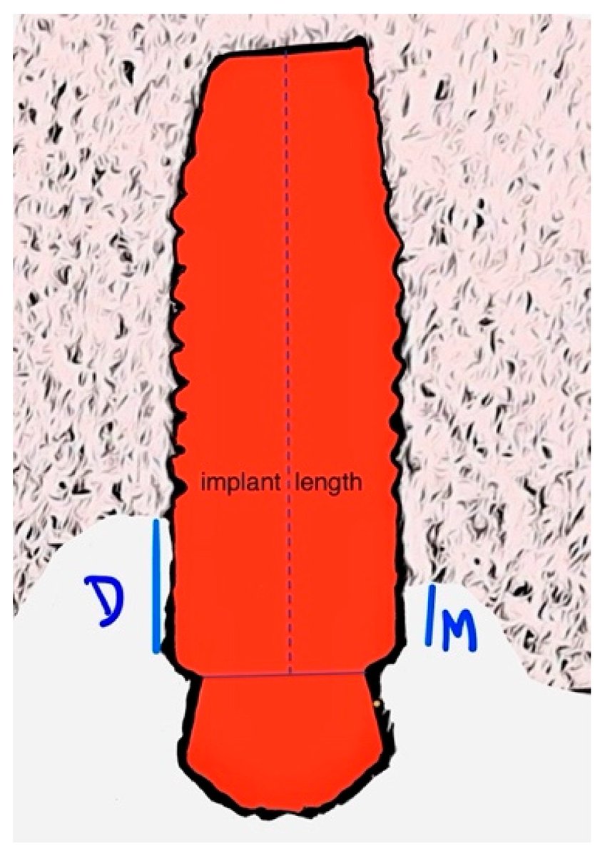 DentistryJ's tweet image. Maxillary #Sinusaugmentation with #Xenogenic Collagen-Retained Heterologous Cortico-Cancellous Bone: A 3-Year Follow-up Randomized Controlled Trial
@UPorto @UnivAveiro
mdpi.com/2304-6767/12/2…
#bone #dentalimplants #graftsurvival
@MDPIOpenAccess @MediPharma_MDPI @DentistryJ