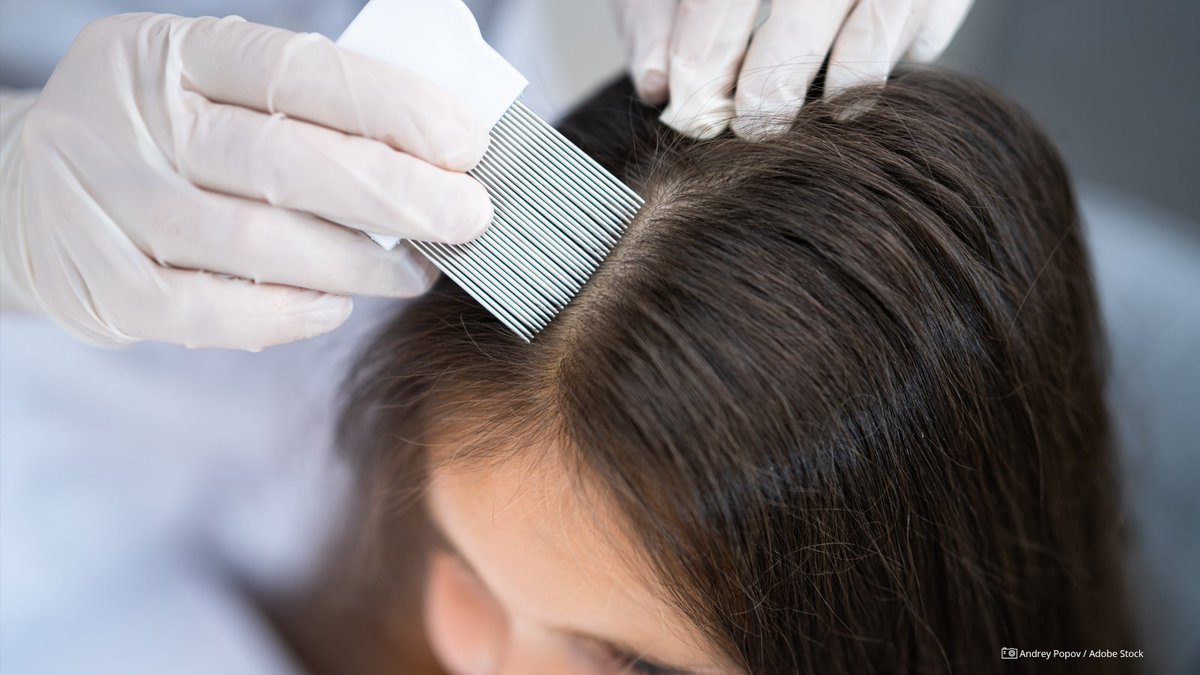 Ein #Kopflaus-Befall in der Kita ist völlig normal: Zwei Biologie-Studentinnen @TUD_Science haben herausgefunden, wie häufig die kleinen Blutsauger tatsächlich vorkommen & dass am Stigma schlechter Hygiene nichts dran ist. 🪮 Mehr dazu ➡️ tu-dresden.de/tu-dresden/new… #TUDresden